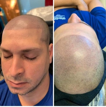 Limitless Beauty Launches Scalp Micropigmentation in Bellingham, Bringing Advanced Hair Restoration Closer to Home